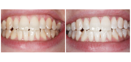 Профессиональная чистка зубов + отбеливание капами Ultradent
