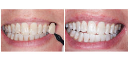 Профессиональная чистка зубов + отбеливание капами Ultradent