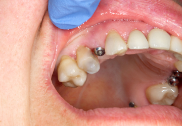 Проблемы с зубными протезами
